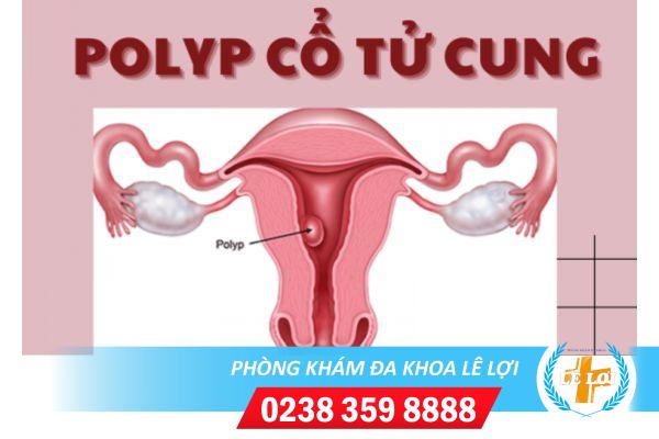 Hinh-anh-polyp-co-tu-cung-1