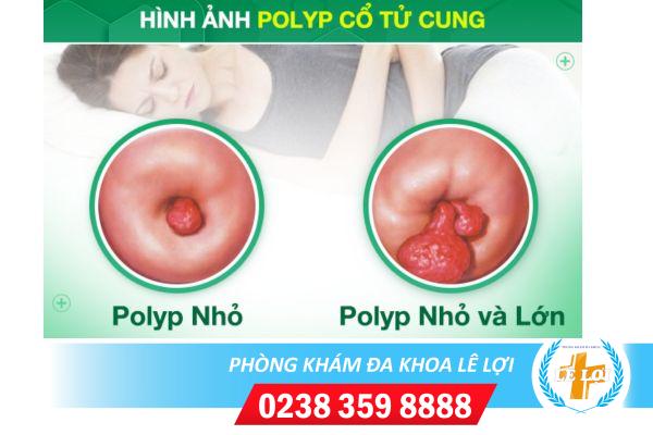 Hinh-anh-polyp-co-tu-cung