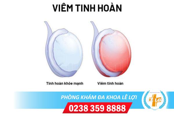 Viem-tinh-hoan