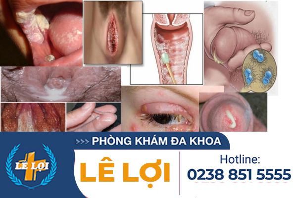 Dau-hieu-lau-ra-sao-cach-nhan-biet