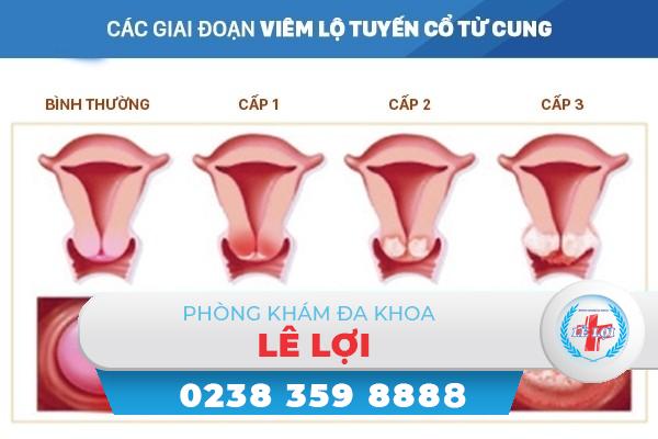 Các giai đoạn viêm lộ tuyến cổ tử cung