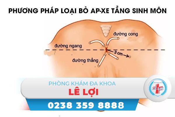 Phương pháp loại bỏ ap-xe tầng sinh môn - Liệu trình một lần duy nhất