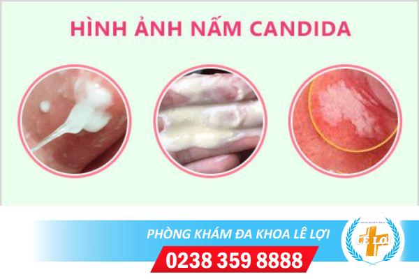 Dau-hieu-nhiem-nam-candida-o-nam-gioi-1