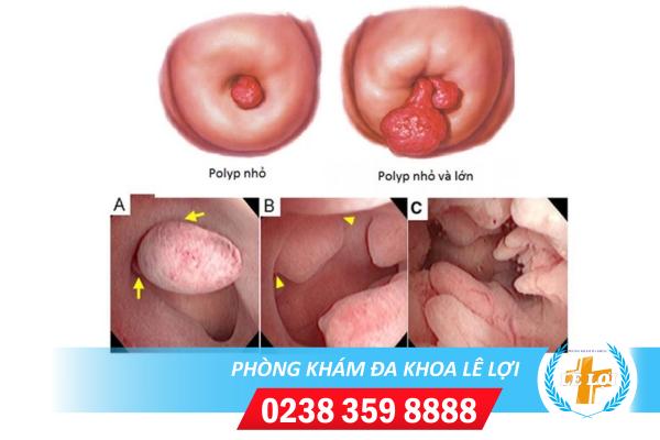 Dot-polyp-co-tu-cung (2)