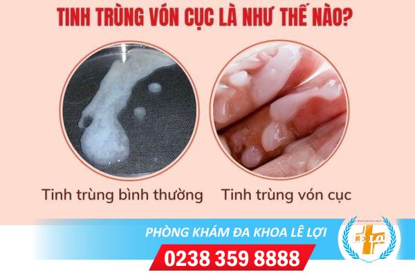 Tinh-trung-von-cuc