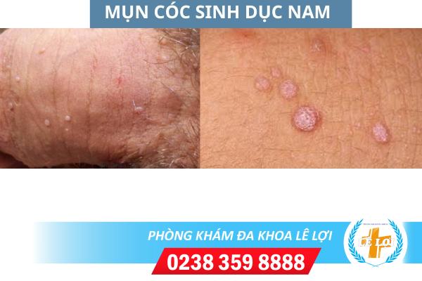 Mun-coc-sinh-duc-nam