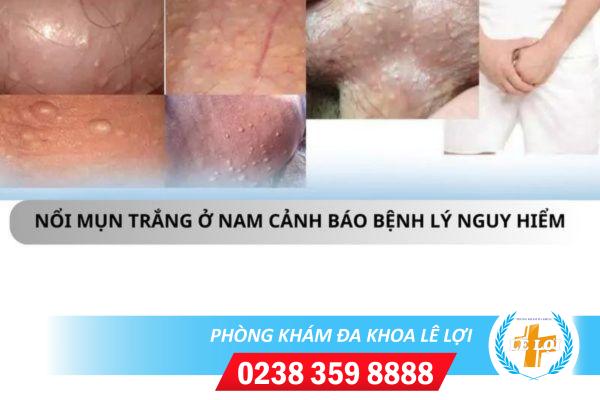 Noi-mun-trang-o-nam-dau-hieu-nhieu-benh-ly-nguy-hiem