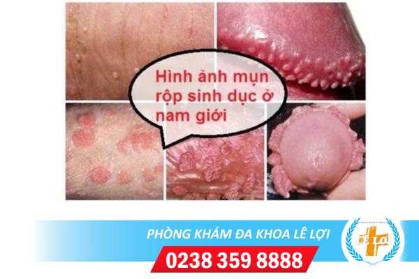 Cach-dieu-tri-herpes-hieu-qua-an-toan