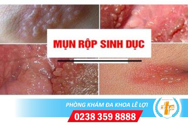 Herpes-vung-kin-la-benh-gi-nguy-hiem-khong