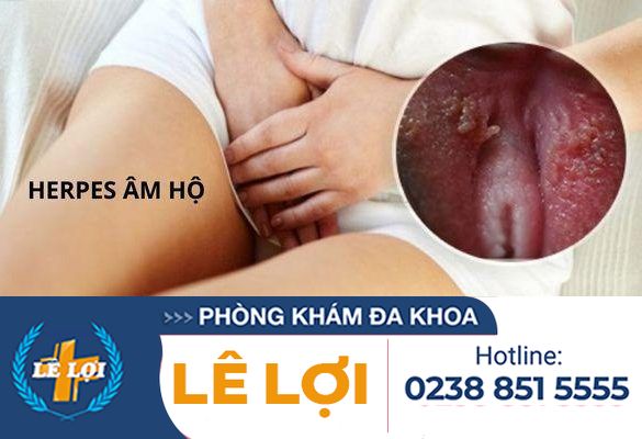 Tổng quan bề bệnh herpes âm hộ và cách điều trị