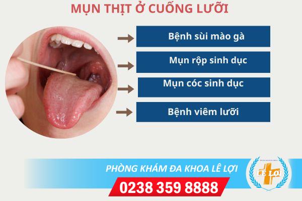 Mun-thit-cuong-luoi-benh-gi