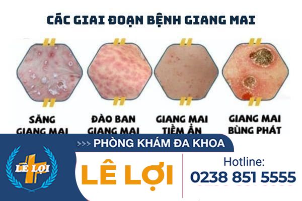 Cac-giai-doan-benh-benh-giang-mai
