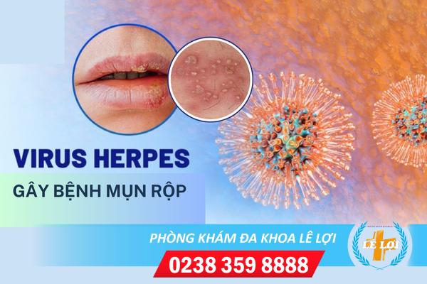 Benh-herpes (1)