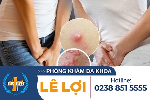 Noi-mun-do-trang-la-benh-gi