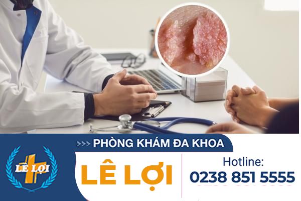 Dia-chi-chua-benh-sui-mao-ga-uy-tin