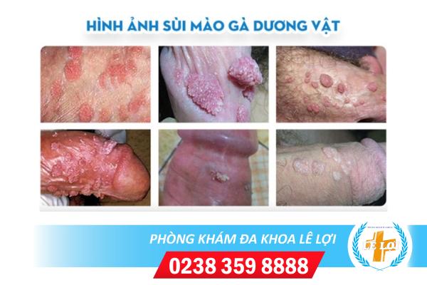 Hinh-anh-sui-mao-ga-o-duong-vat